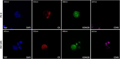STIM1, ORAI1, and KDM2B in circulating tumor cells (CTCs) isolated from prostate cancer patients
